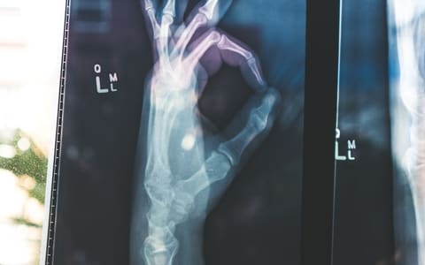 Ankle Impingement