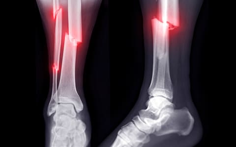 Fracture Care
