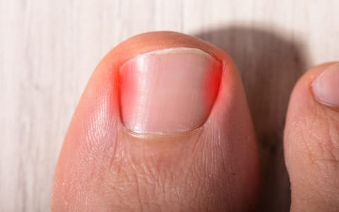 Ingrown Toenails