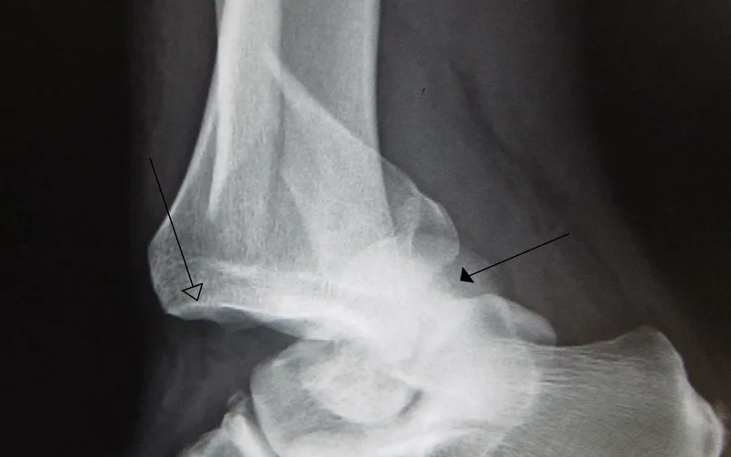 Foot and Ankle Dislocations treatment at Bends Foot and Ankle in Chillicothe, Ohio